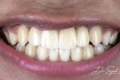 How All-On-4 Dental Implants Work For Replacing Missing Teeth